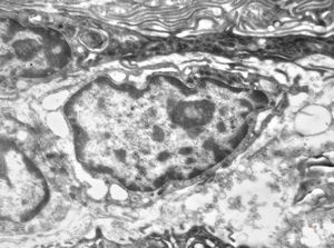 F,41y. | synovial metaplasia - capsule of implantate F,41y. | synovial metaplasia - capsule of implantate